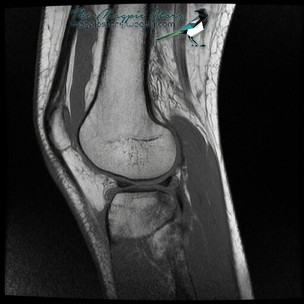 mri acl knee left scan torn meniscus tear after weebly
